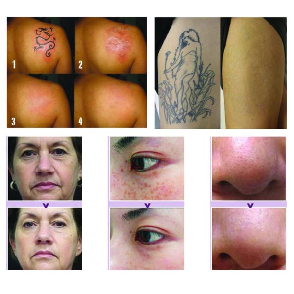 Eyebrow Tattoo Removal Laser Beauty Machine , Nd Yag Laser Tattoo Removal Machine