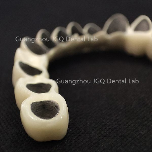 Dental Pfm Crown and Bridge Restorations for Dental Care China Dental Laboratory