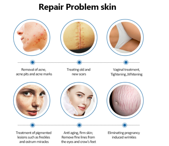 60W Fractional CO2 Laser Machine Scar Removal Skin Rejuvenation / Resurfacing