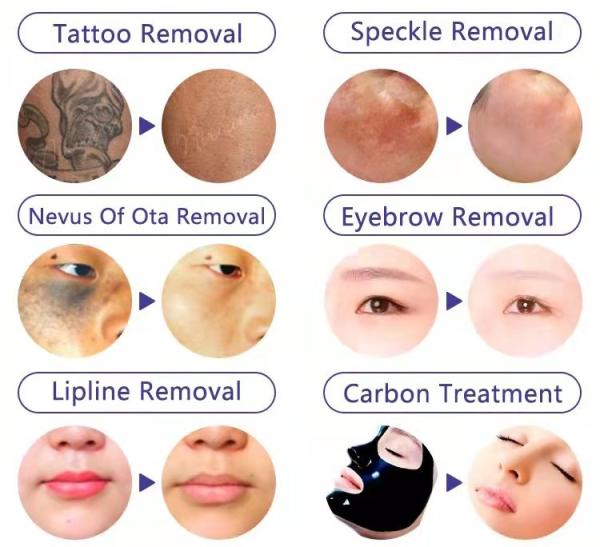 Portable 755nm Picolaser Tatoo Remover Q Switch Nd Yag Picosecond Laser Tattoo Removal Machine