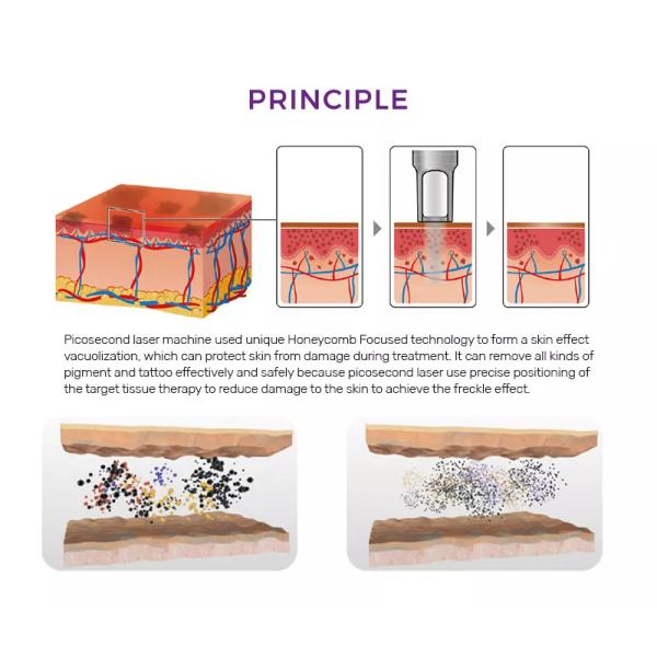 Brazo láser de Corea importado 1064 532 755nm láser de picosegundos para la eliminación de tatuajes