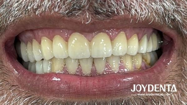 Prothèses en zirconium qui imitent les dents naturelles