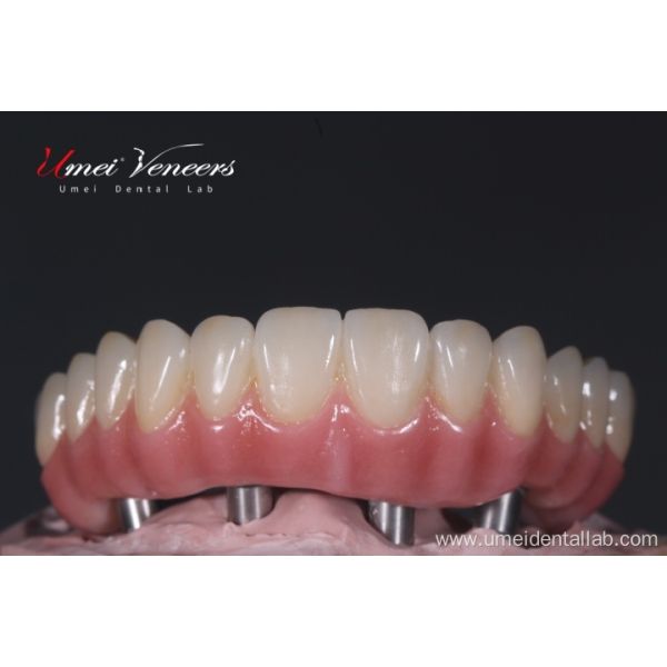 Biocompatible Titanium Marlow Bridge