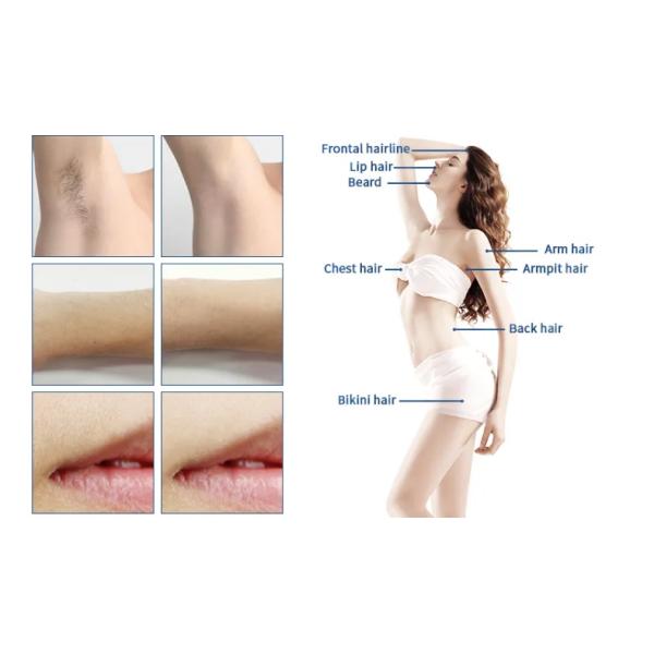 755nm 808nm 1064nm Laser Diodo Hair Removal Machine 20 Millions Shots Life