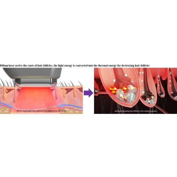 1064nm Laser Hair Removal Machine