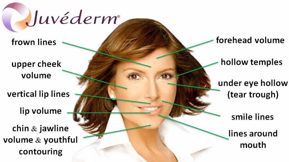 Салоны Juvederm Hyaluronic Acid Fillers Инъекционные препараты для лица и кожные наполнители 24 мг/мл