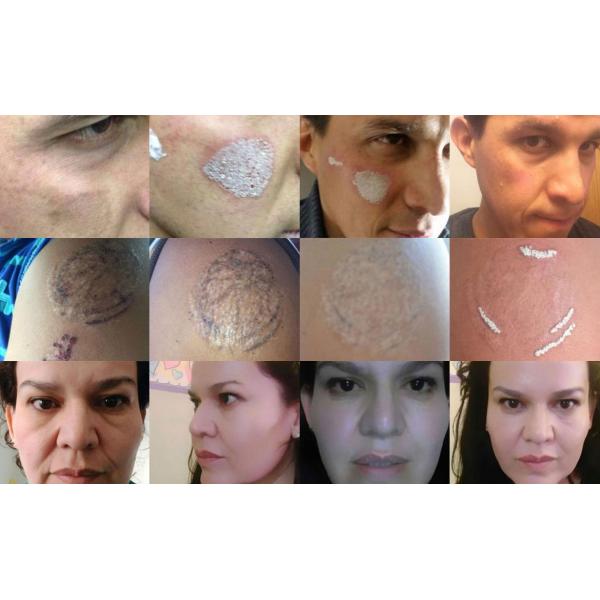 Pain Free Multi Function Laser 3 Handpiece , 808 Nm Hair Loss Laser Machine