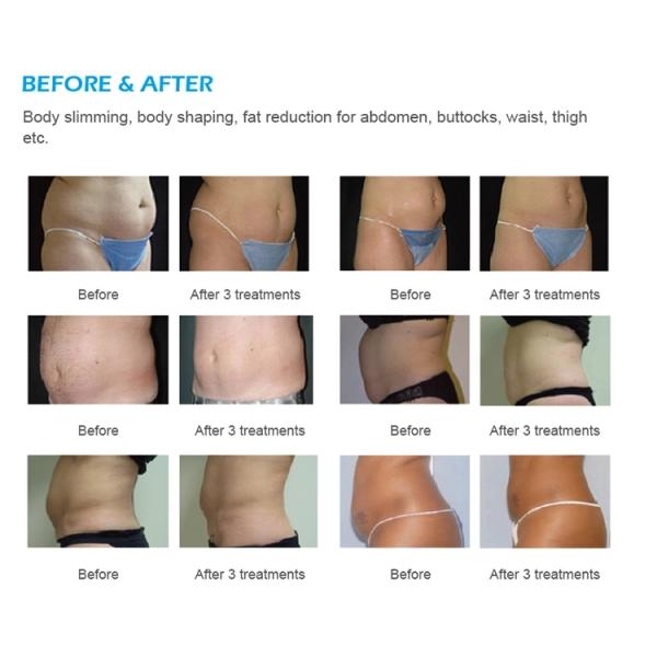 Hot Sale Slimming HIFU Focused Ultrasound Beauty Equipment Hifu Slimming