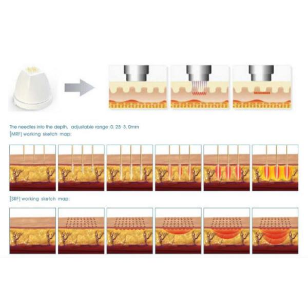 Fractional Radiofrequency Micro Needling Machine For Skin Rejuvenation 25/49/81 Pins 5MHZ