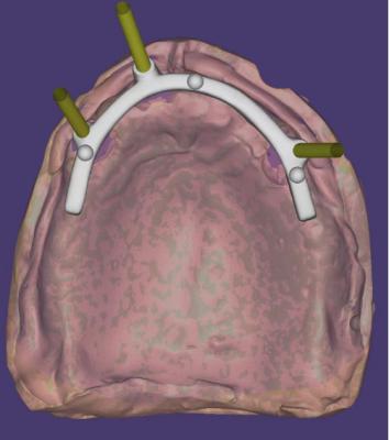 Customized Dental CAD CAM Design High Precision For Implant Supported Bar