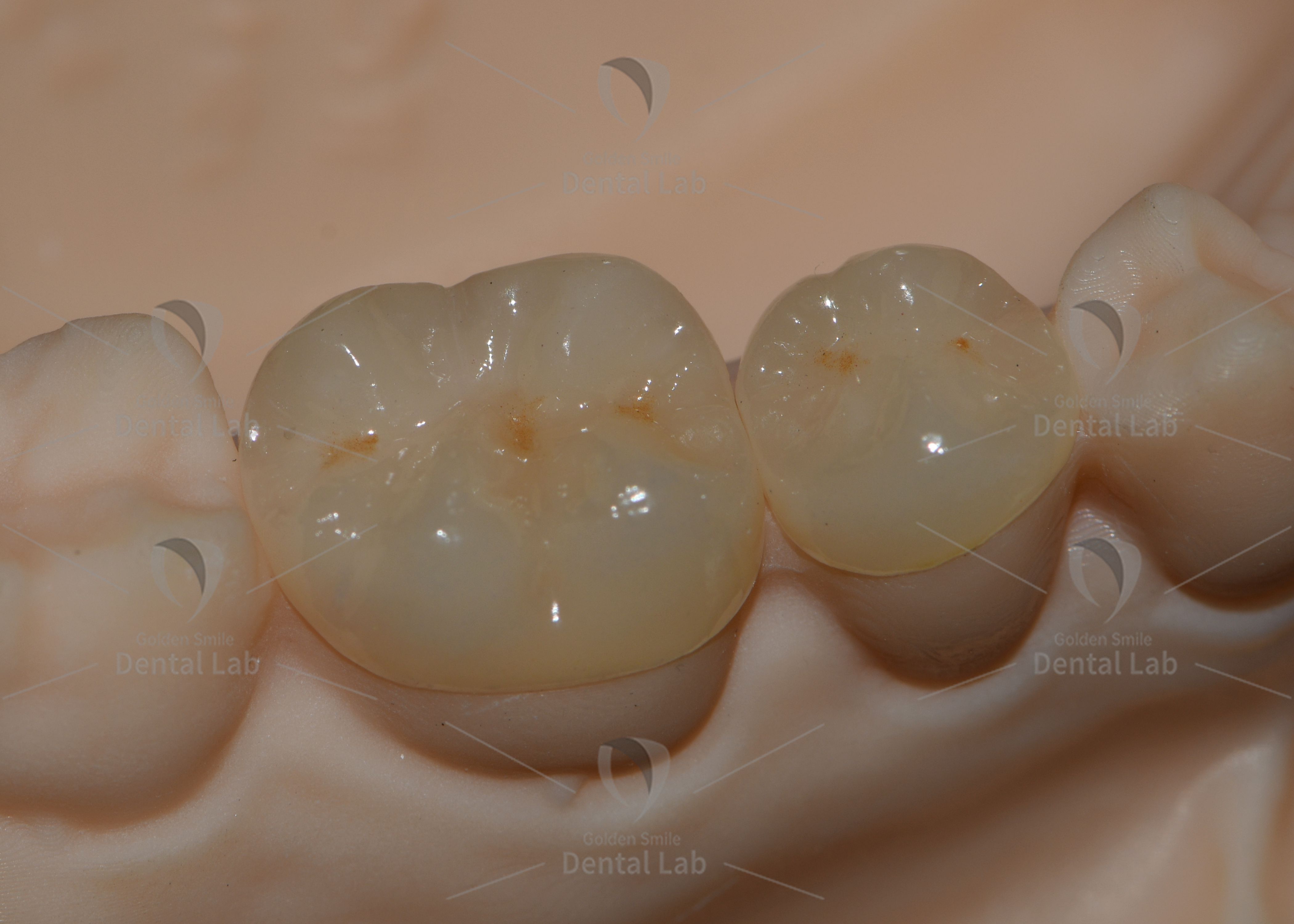 Lithium Disilicate Pressed Ceramic Onlays with Biocompatibility, Natural Aesthetics, and High Strength for Posterior Teeth Restoration