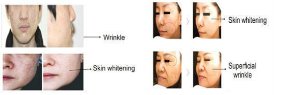 Multifunctional White Professional Ipl Hair Removal Machine Effective Weight Loss