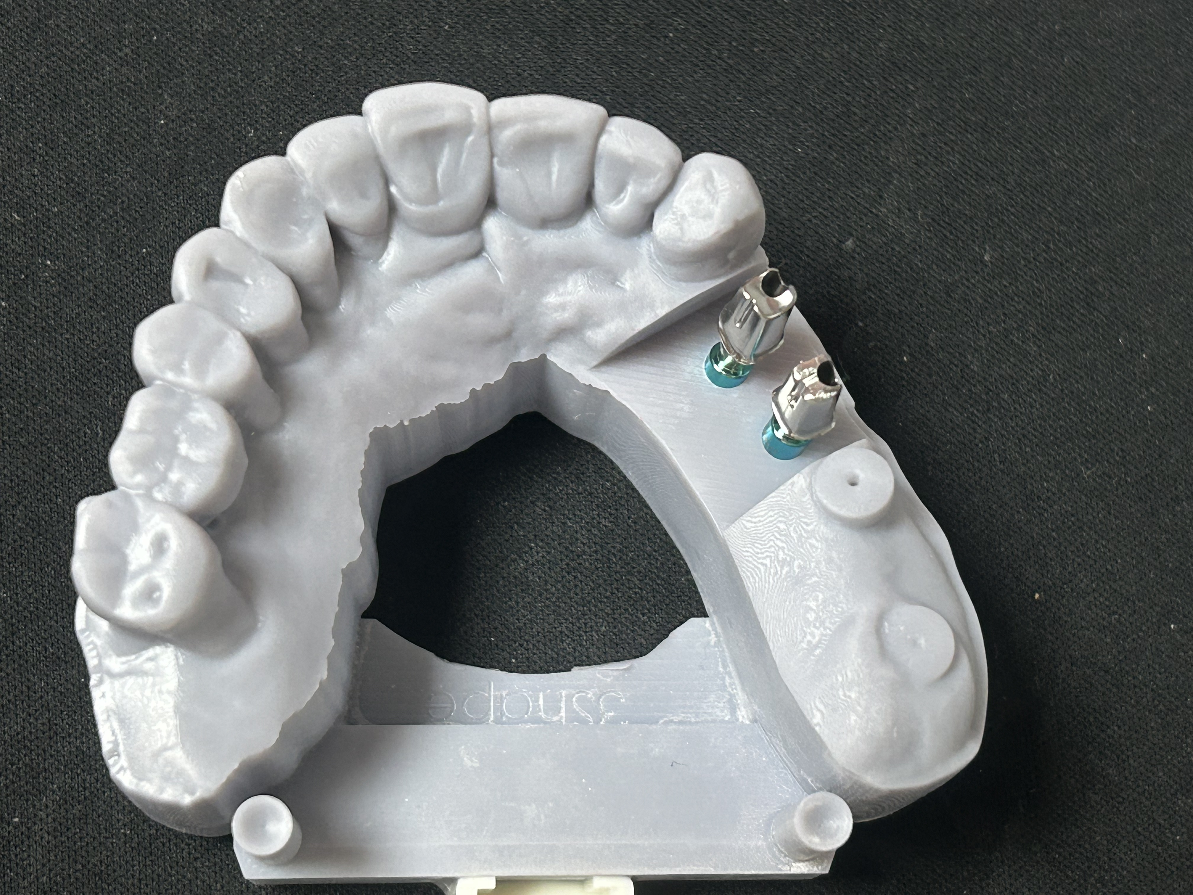 High-Strength Zirconia Implant Restoration with Natural-Looking Appearance and Digital CAD/CAM Manufacturing