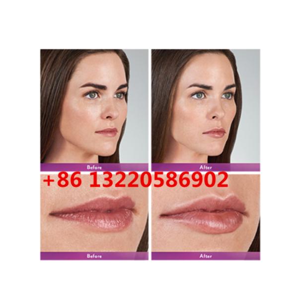 Juvederm ультра 3 ультра 4 заполнитель Voluma 2ml Hyaluronic кисловочный дермальный