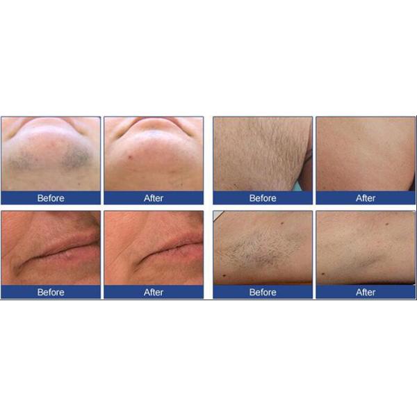 600W High Power multifunctional beauty equipment 808nm diode laser hair machine for sale