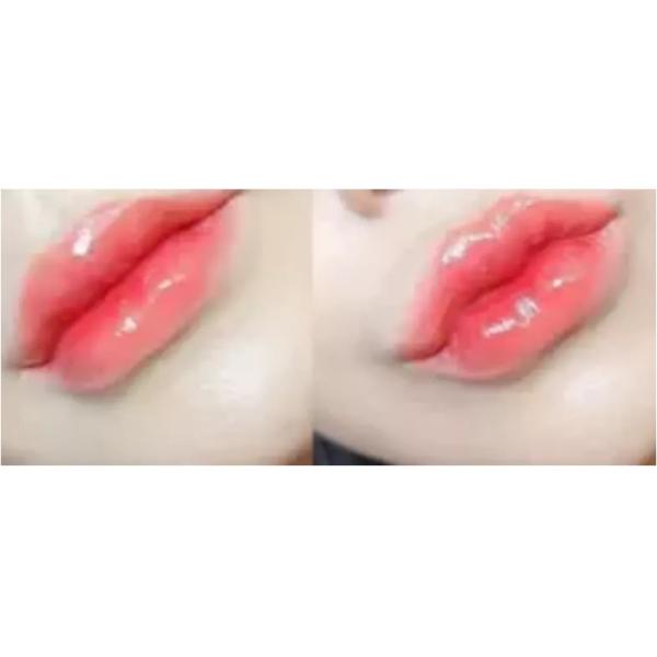 Заполнитель груди ультра 4 Juvederm Hyaluronic кисловочный вводимый