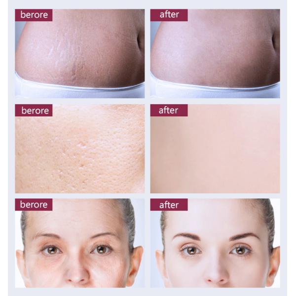 Частичный лазер СО2 10600 Nm применяет обложку к Resurfacing удаление меток простирания машины