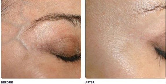 машина удаления волос лазера диода 980nm, вена спайдера и машина удаления Vasuclar