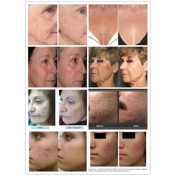 2016 hot selling RF pipe Co2   fractional laser for skin resurfacing and vagina tightening