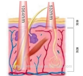 Discount price! Discount price! nd yag laser tattoo and nail fungus removal for tattoo removal, age pigment & freckle re