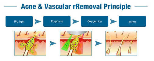 IMED profesional LaserTell de la máquina del retiro del pelo del OPT del rejuvenecimiento IPL SHR de la piel