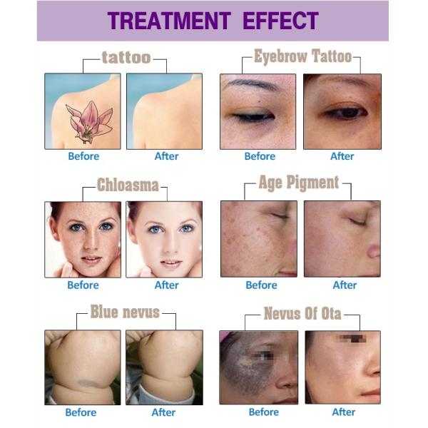 Máquina portátil de depilación con láser Nd YAG de pulso largo para uso comercial