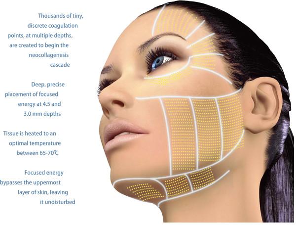 high frequency HIFU face firming HIFU-f  machine radio frequency laser invasive lipo skin tightening
