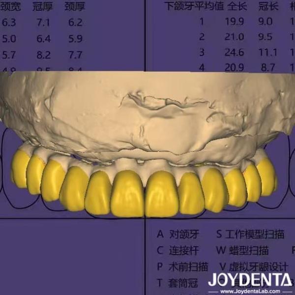 Dental Design Software Digital Wax Up With HIPAA Compliant Data Security