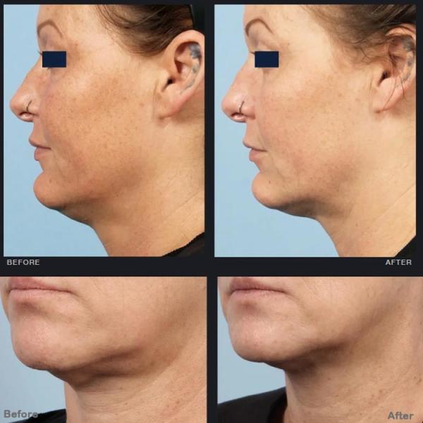 Rf Power Microneedling Fractional Rf Microneedle Scarlet Устройство с вакуумом