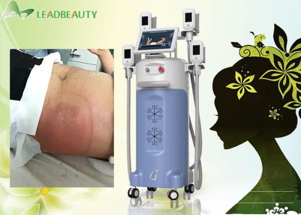 4  big handles Great weight loss-15 ~5Celsuis degree machine cryolipolysis
