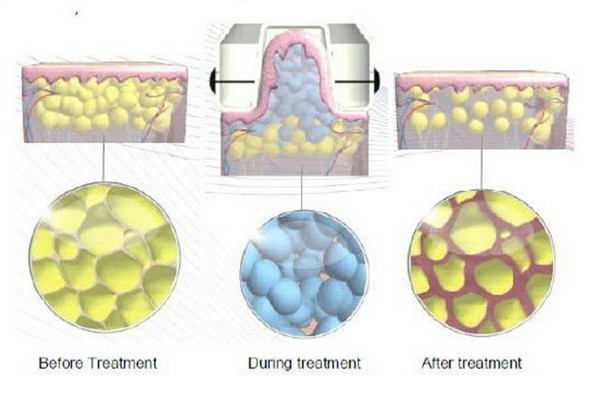 Vacuum Cryolipolysis Slimming Machine / Four Handles Coolsculpting Equipment