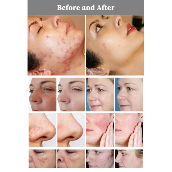 Portable New 1927nm Thulium Laser for Melasma Laser 1927 Thulium Micro Ablative 1927 Non Ablative Laser Thulium Facial Laser