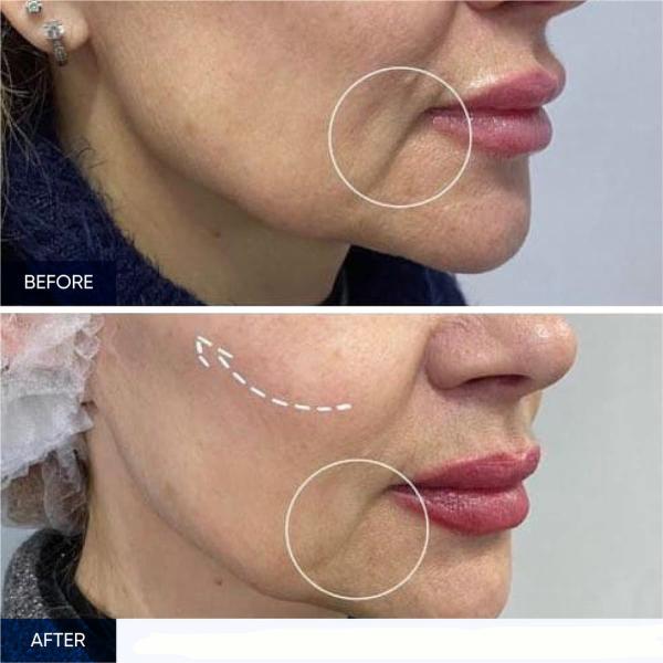 7d HIFU Máquina Facial de Eliminação de Rugas Emagrecimento de Pele Lifting Systerm Para Salão de Beleza