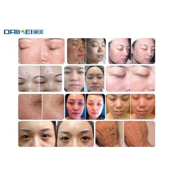 Seyo Needle Free Mesotherapy Machine / Water Mesotherapy Machine CE Approved