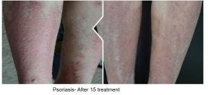 Light Vitiligo Excimer Laser Machine 9.2kg XeCl Lamp UVB Phototherapy