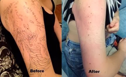 Ce Approval Long Pulsed Nd Yag Laser , 800w Yag Laser Tattoo Removal Machine