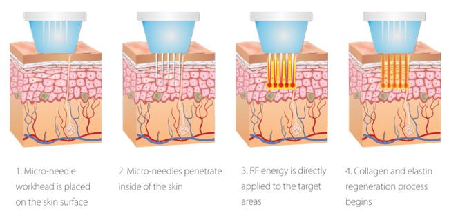 Игла подмолаживания 0.2MM кожи Microneedling частичная RF экрана касания