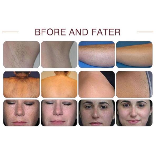 Pain Free Permanent Hair Removal Devices , Professional Acne Treatment Machine