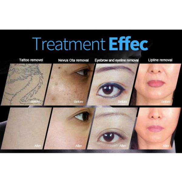 Машина удаления татуировки лазера Pico обработки кожи, лазер ND YAG переключателя 2000W q