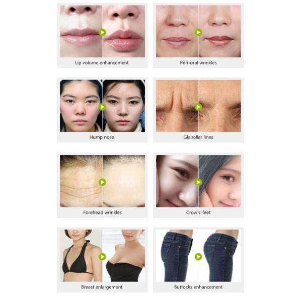 Крест 2 Ml кисловочный Hyaluronic соединил дермальные впрыски заполнителя губы заполнителя