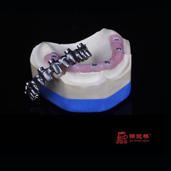 3D Printing Titanium Bridge Malone Glazed for Dental Implant Case