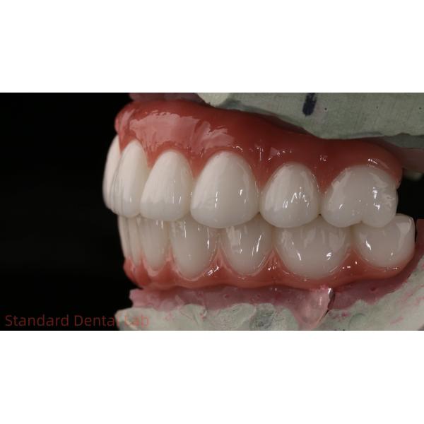 Высококачественная зубная цирконовая корона и All On Four Six Implant Full Arch / Китайская стоматологическая лаборатория