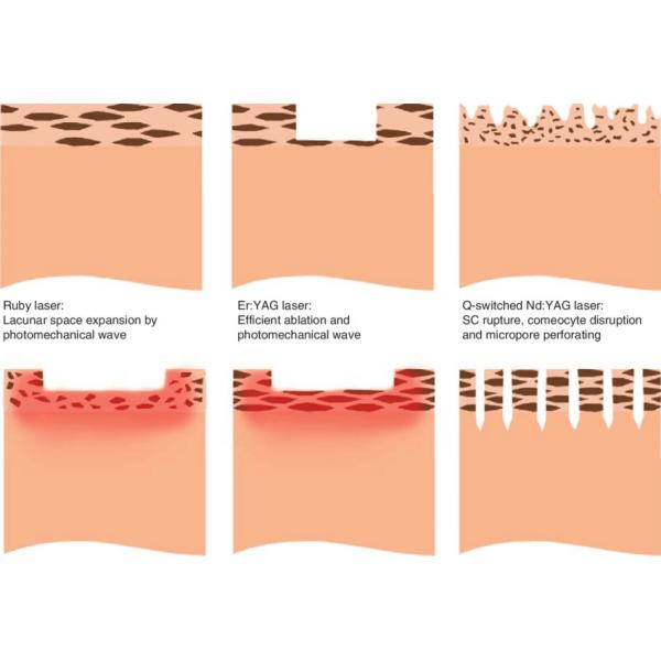 Efficient Q Switch Tattoo Removal Machine Laser Tattoo Removal Equipment 1 - 10Hz Frequency