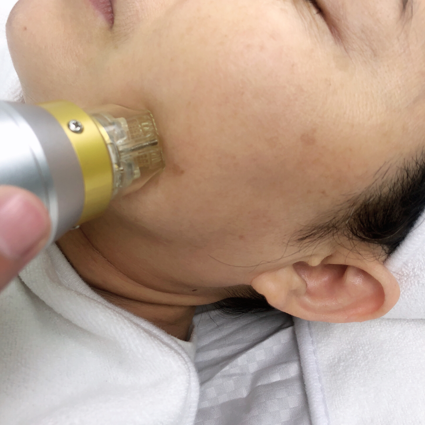 Кожа Resurfacing частичная машина RF Microneedle с холодной терапией инвазионной