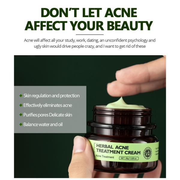 Нежная сливк 30g обработки угорь заботы кожи для кожи угорь прональной чувствительной