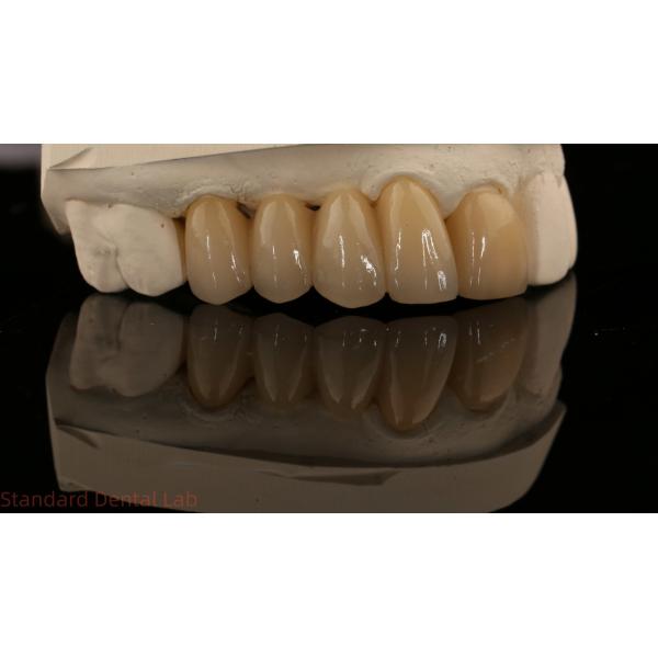 Noritake Porcelian Full Contour Zirconia Crown High Aesthetic Natural Customized Zirconia Dental Bridge