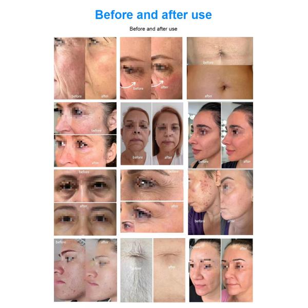 Rejuvenecimiento de la piel Eliminación de arrugas Rostro de la piel del rostro 12D Hifu máquina