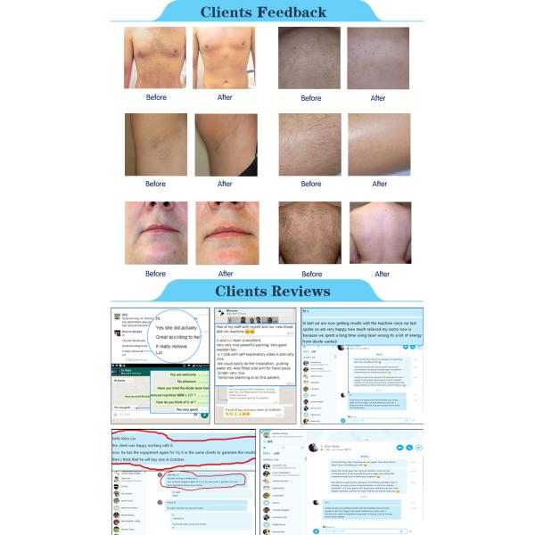 Nubway salon use beauty equipment 808 nm laser hair removal machine for spa