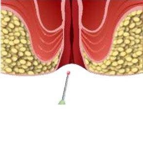 Dual Wavelength Laser 980nm 1470nm for Anal Fistula Hemorrhoid Proctology