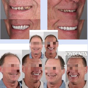 Dentaduras de zirconia que imitan los dientes naturales